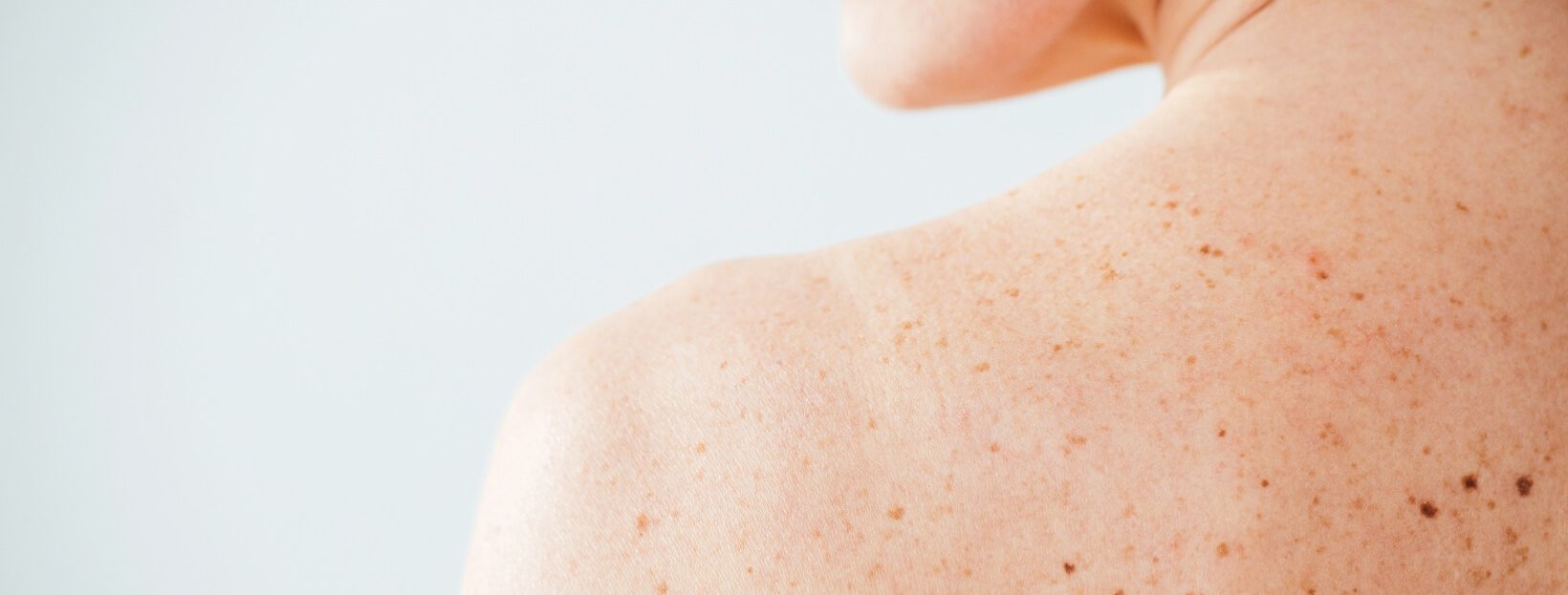 trosyd micosi cutanee