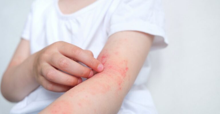 Irritazione o infezione cutanea? Come distinguerle.